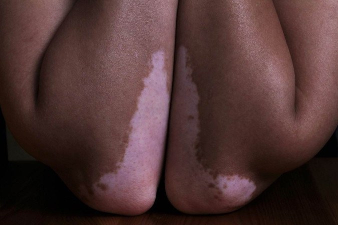 Pele marcada: conheça as características do vitiligo e como tratá-lo